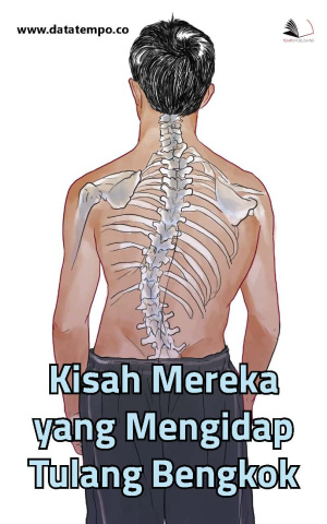 Kisah Mereka yang Mengidap Tulang Bengkok